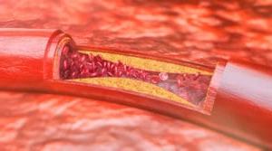 Peripheral Artery Disease (PAD) treatment